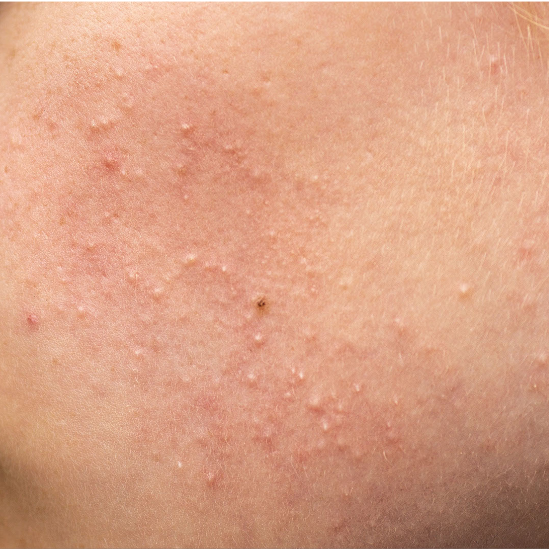 What is acne cosmetica and how do I treat it DERMALA